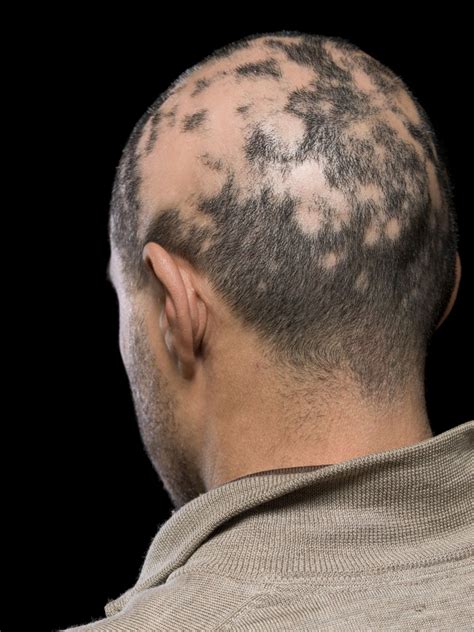 Alopecia .
